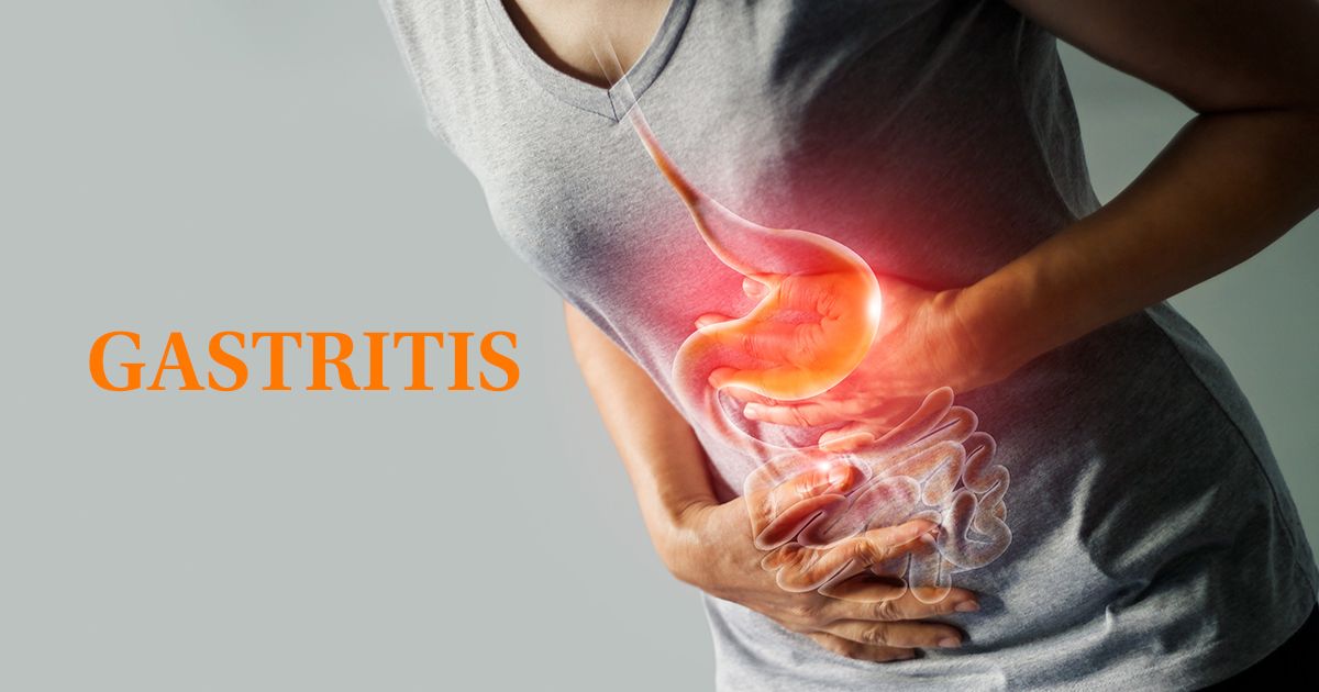 Cómo tratar la gastritis de forma natural