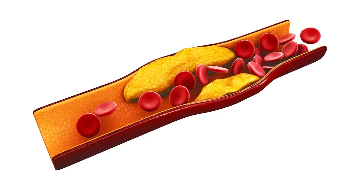 Esta poderosa vitamina evita que sus arterias se obstruyan