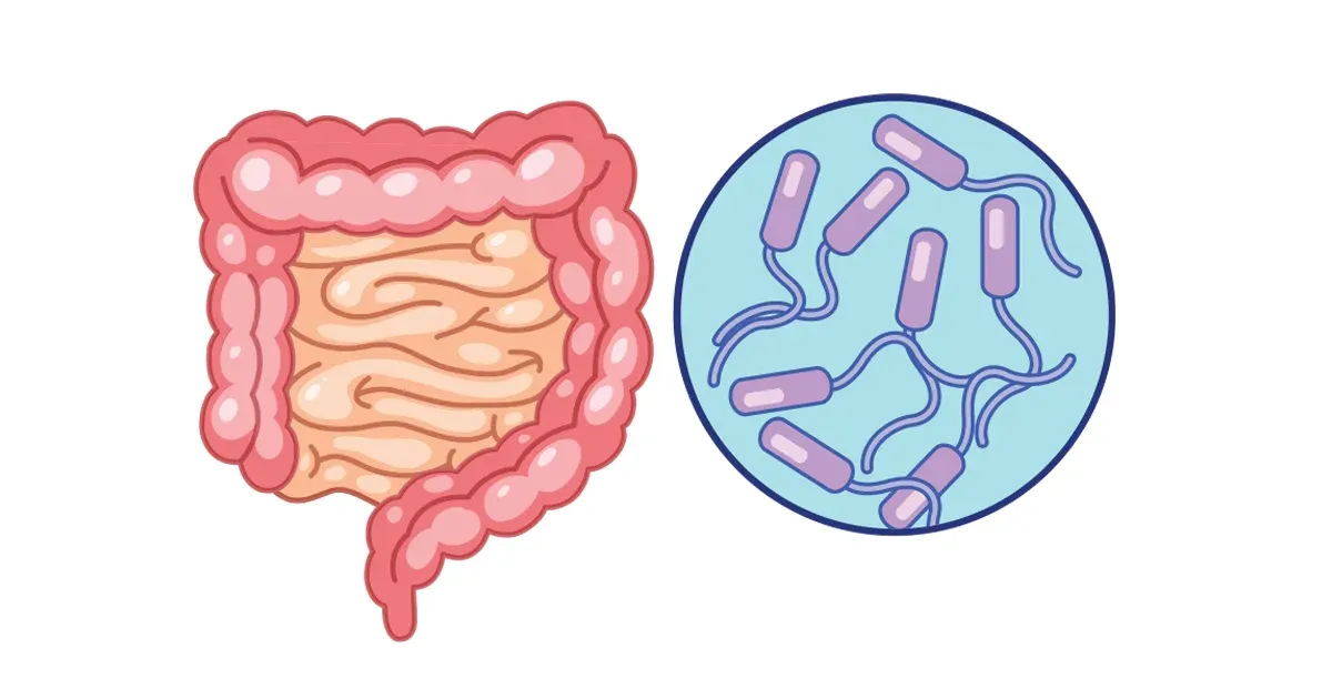 La bacteria que causa preocupación a nivel mundial por su relación con el cáncer