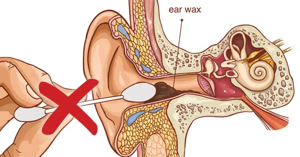 Por qué no debería utilizar hisopos de algodón para limpiar sus oídos