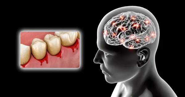 Esta enfermedad bucal podría incrementar su riesgo de padecer alzhéimer