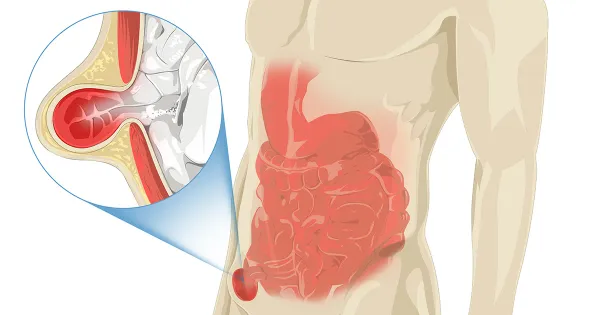Este tipo de hernia puede poner su vida en peligro